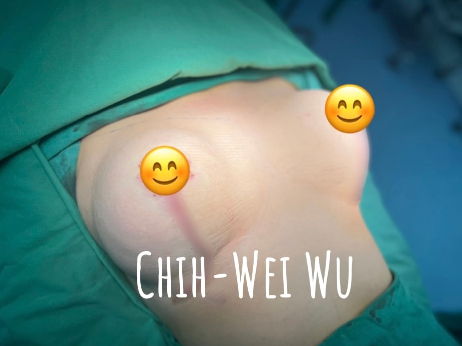 2022年8月微笑提乳隆乳立即術後照，微笑提乳是吳醫師發明的提乳手術技術，效果立即顯著且持久！