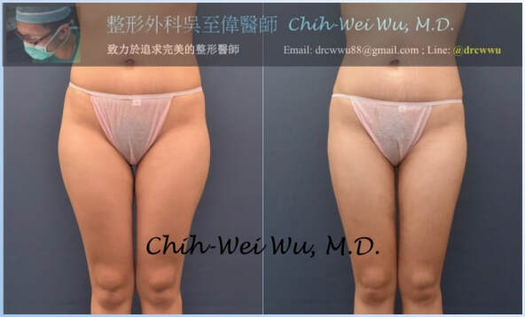 圖片大腿抽脂