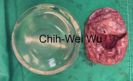 清莢膜，莢膜攣縮