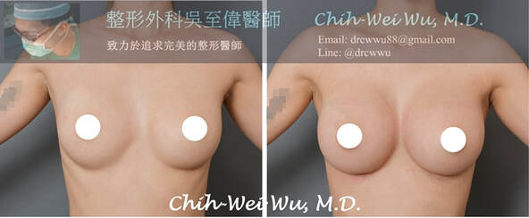圖片2020年二月最新胸下緣隆乳案例