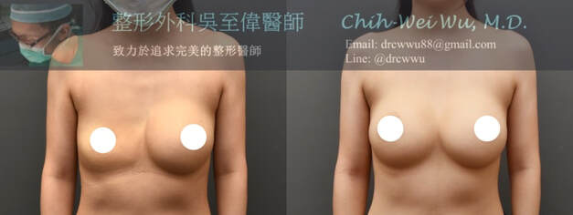 此案例為隆乳10年後單側鹽水袋假體破裂，二次隆乳時僅更換該側假體為果凍矽膠，術後一樣可以外觀接近對稱且手感接近。