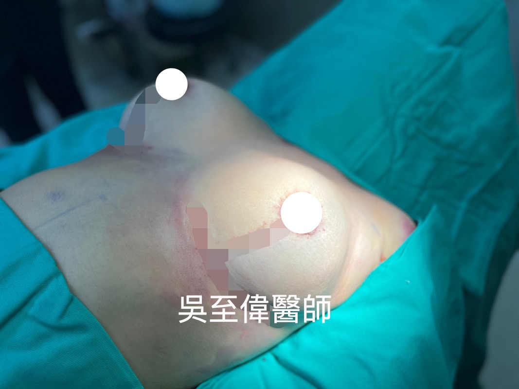 縮胸手術權威吳至偉醫師