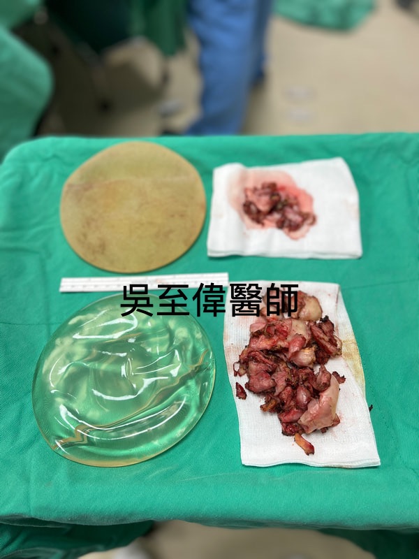 二次隆乳手術，術中取出假體與完全切除增厚的莢膜