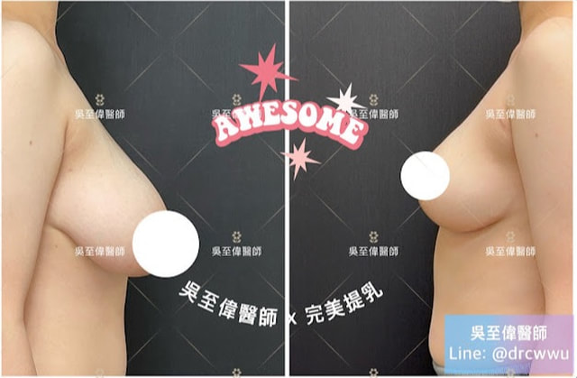 最新提乳案例，在二度下垂，合併上胸嚴重凹陷的胸型，採用垂直切口提乳，合併假體隆乳，可以得到令人滿意的效果〔提乳權威吳至偉醫師〕