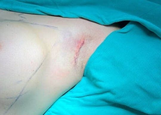 隆乳的傷口通常會以防水膠黏合