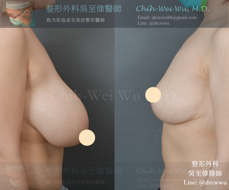 過大與下垂的胸部，接受縮胸提乳手術，可改善負擔過大，肩頸酸痛的困擾，術後18個月追蹤。  Relief of shoulder pain and back soreness by breast reduction and lift surgery for breast hypertrophy and ptosis. 18 months follow-up.   #breastreduction #breastlift  #縮胸 #提乳 #乳房下垂 #吳至偉醫師 更多資訊請參考： /3230233016.html