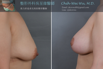 產後鬆弛與下垂，接受提乳與隆乳可得到令人滿意的結果，術後五個月。  A satisfying and pleasant result after breast lift and augmentation for postpartum breast ptosis, 5 months follow-up.   #breastlift #breastaugmentation #產後隆乳 #乳房下垂 #提乳 #吳至偉醫師