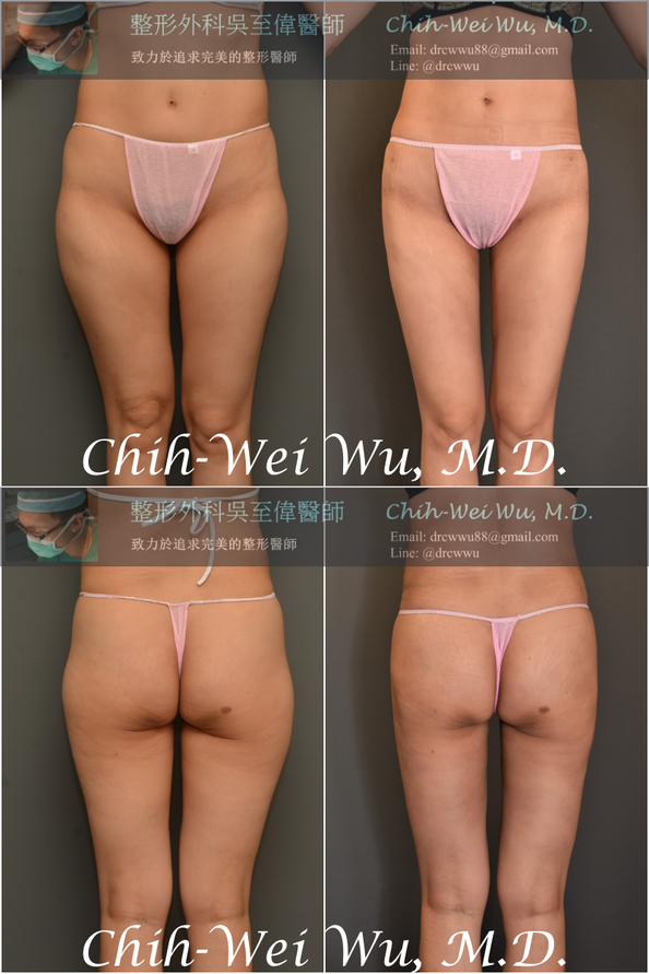 圖片大腿抽脂，自體脂肪豐臀