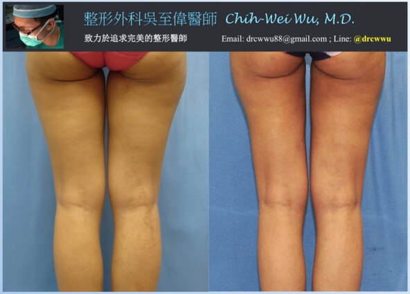 大腿抽脂