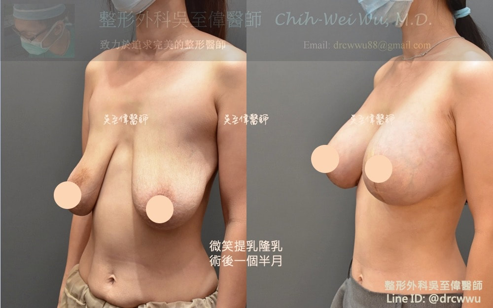 棒棒糖提乳合併魔滴隆乳，術後一個半月