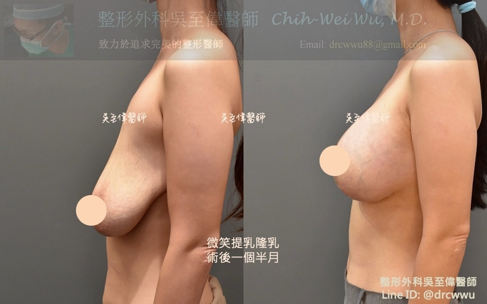 棒棒糖提乳合併魔滴隆乳，術後一個半月