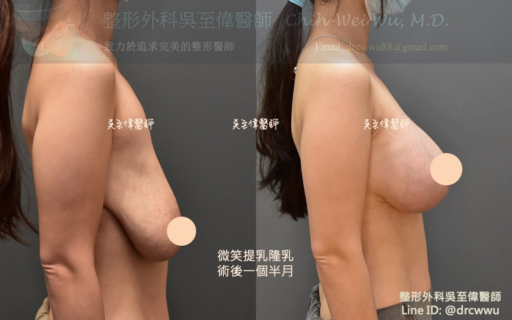 棒棒糖提乳合併魔滴隆乳，術後一個半月